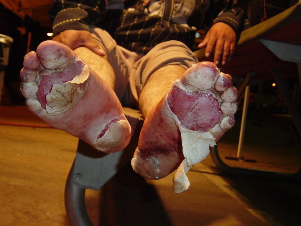 Una muestra de los estragos causados en los pies de este migrante después de caminar largas distancias en el desierto. Foto: Cortesía CBP